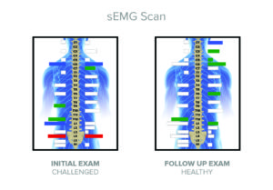 CLA Insight Scan: sEMG Scan